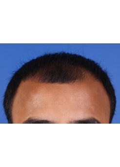 Before Hair Transplant&nbsp;Front